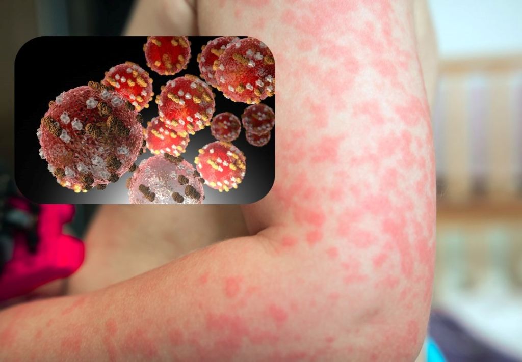 Close-up of a rash or skin condition on a person's arm, with a magnified view of the viral particles causing the condition.